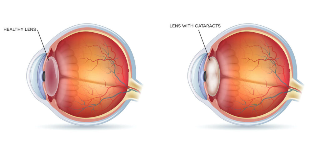 Illustration of healthy eye vs eye with cataracts