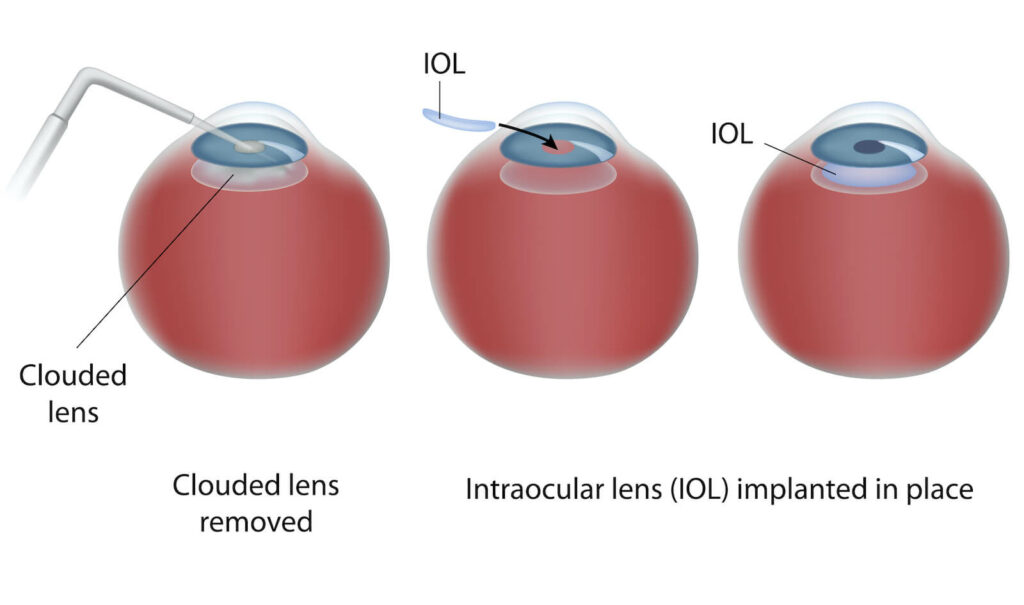 Diagram showing how cataract surgery is done