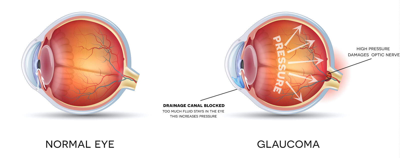 Glaucoma and healthy eye detailed structure