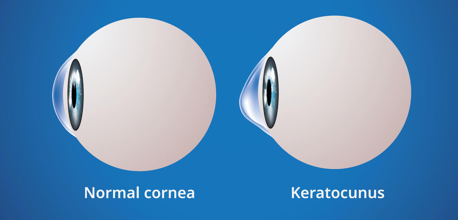 Comparison or norma cornea and keratoconus