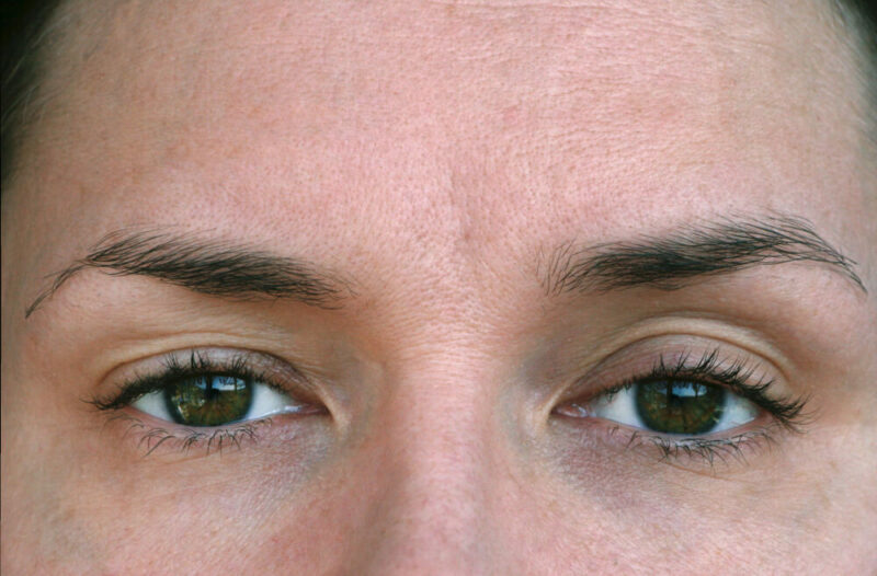 Closeup of a woman's eyes with ptosis